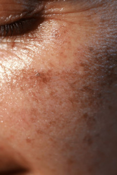 Najlepsze sposoby na pożegnanie z przebarwieniami