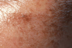 Najlepsze sposoby na pożegnanie z przebarwieniami