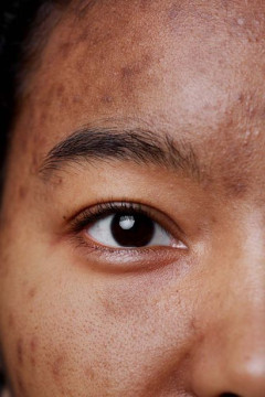 Najlepsze sposoby na pożegnanie z przebarwieniami